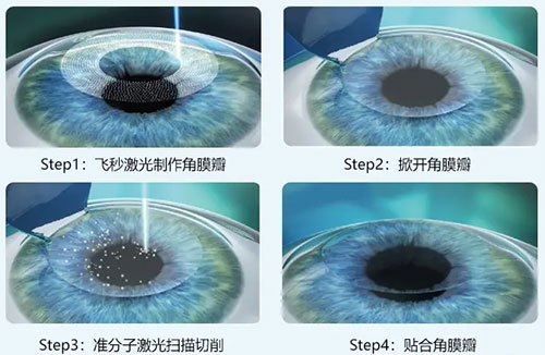 近视手术大概多少钱，近视手术价格一览表